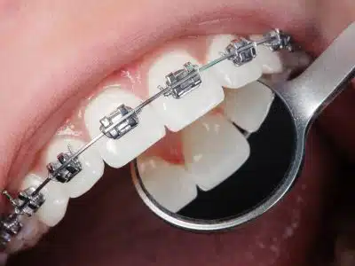 How to Know If You Need Braces