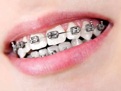 Braces Sports: Must-Know Protection Tips for Athletes