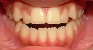 Bite Issues After Invisalign: Expert Solutions for a Perfect Fit