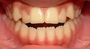 Bite Issues After Invisalign: Expert Solutions for a Perfect Fit