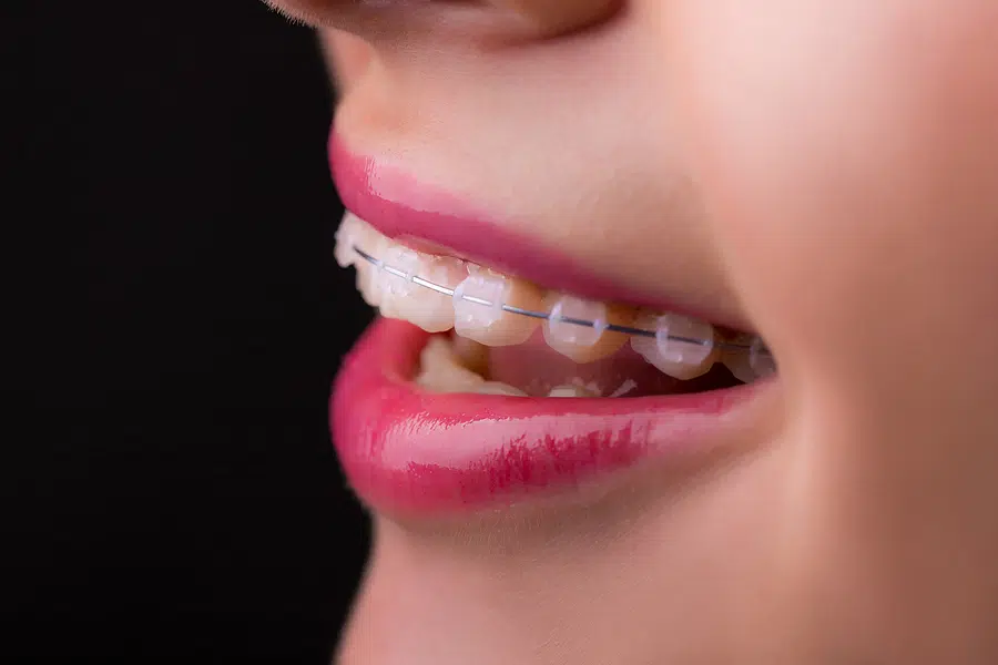 Close up of a teenage girl wearing clear ceramic braces