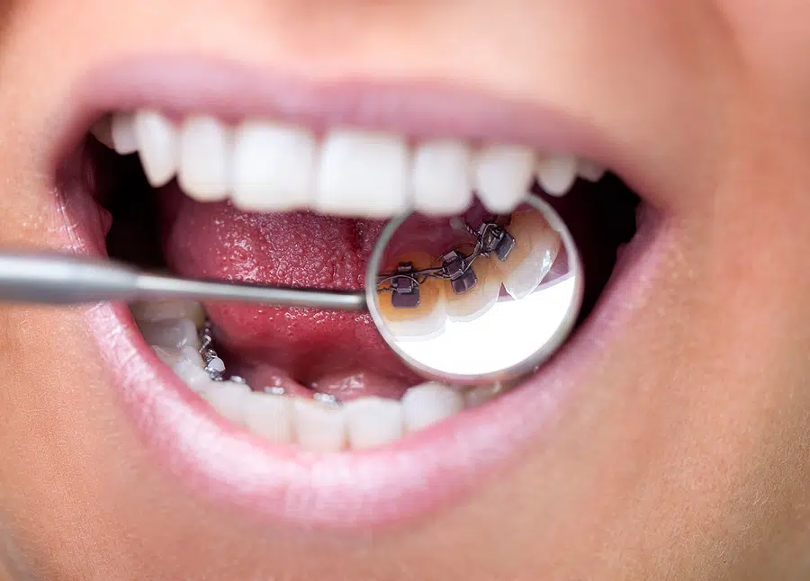 Close up of a person's mouth who is wearing hidden or lingual braces