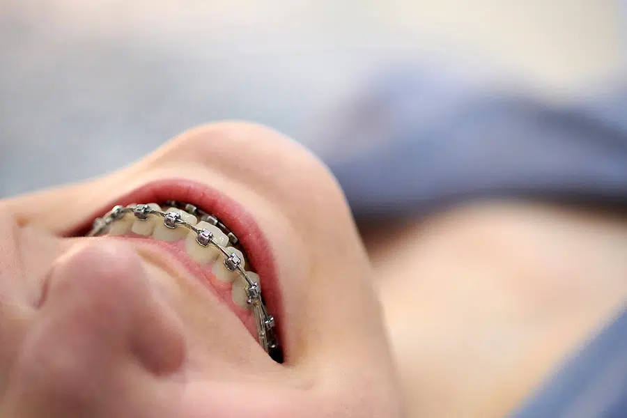 Close up of a teenage girl mouth wearing Damon Braces