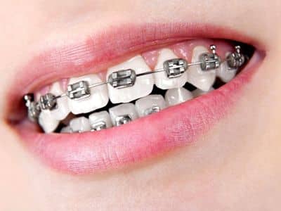 Adult Braces
