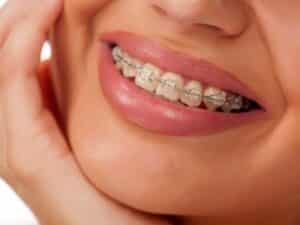 Types of Braces for Adults