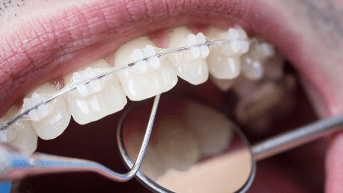 Post-Braces Diet: Top Foods to Ensure Fast Recovery