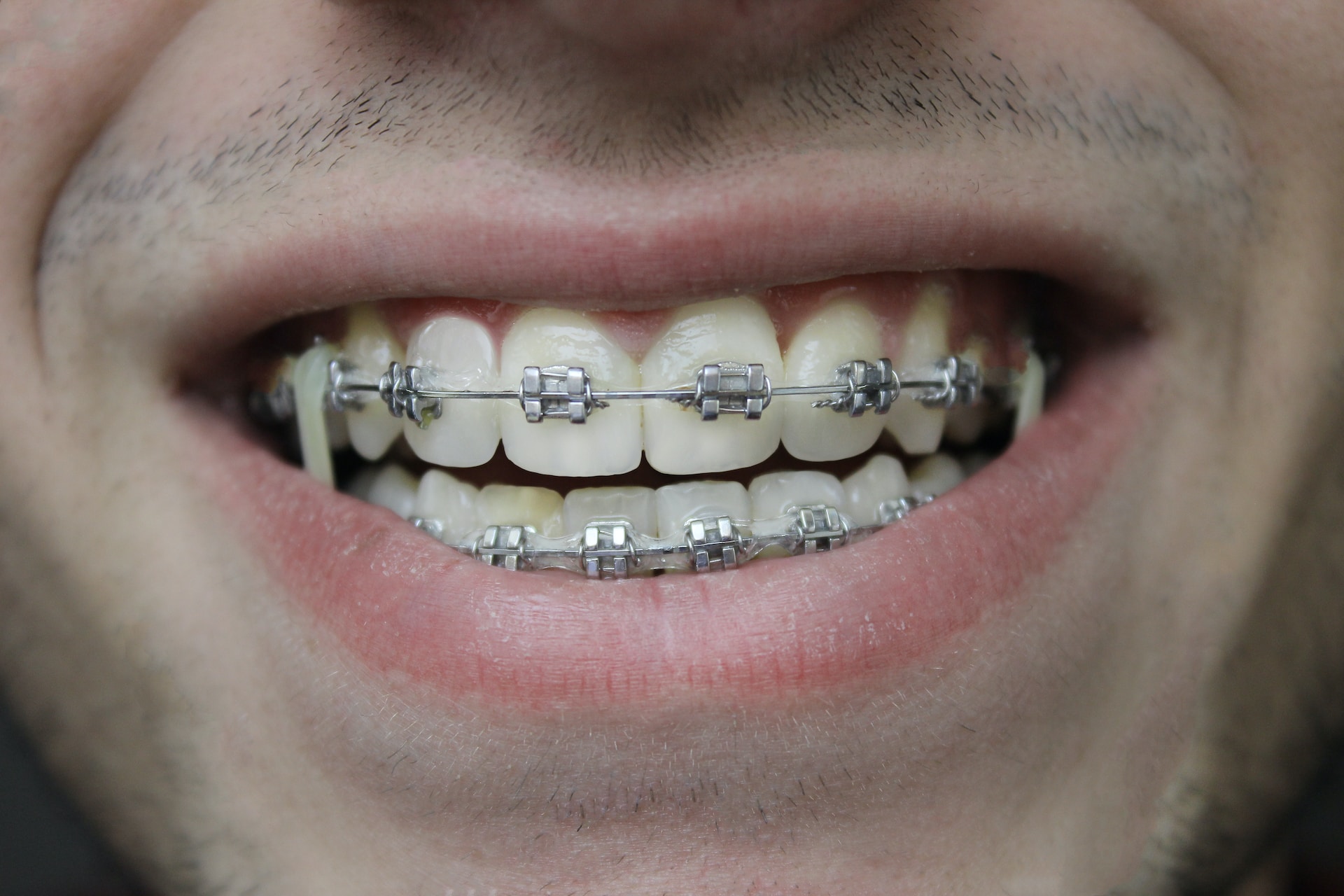 Braces in Brooklyn, NY Halabie