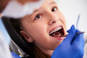 What's the Best Age to Get Braces? Critical Tips for Perfect Timing