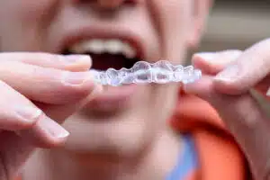 Invisalign Improves Oral Health: Advantages of Straighter Teeth