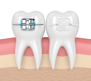 Which Braces Are Right for You? Finding the Ideal Solution