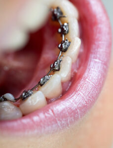 Which Braces Are Right for You? Finding the Ideal Solution