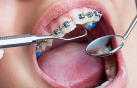 Orthodontic Treatment