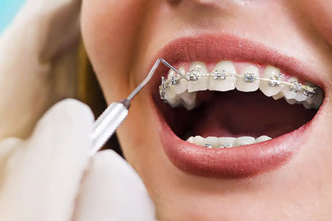 Orthodontic Treatment