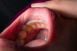 Mouth Sores from Braces: Fast Relief with These Expert Tips