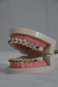 Braces Bands Colours: Top Picks to Express Your Style