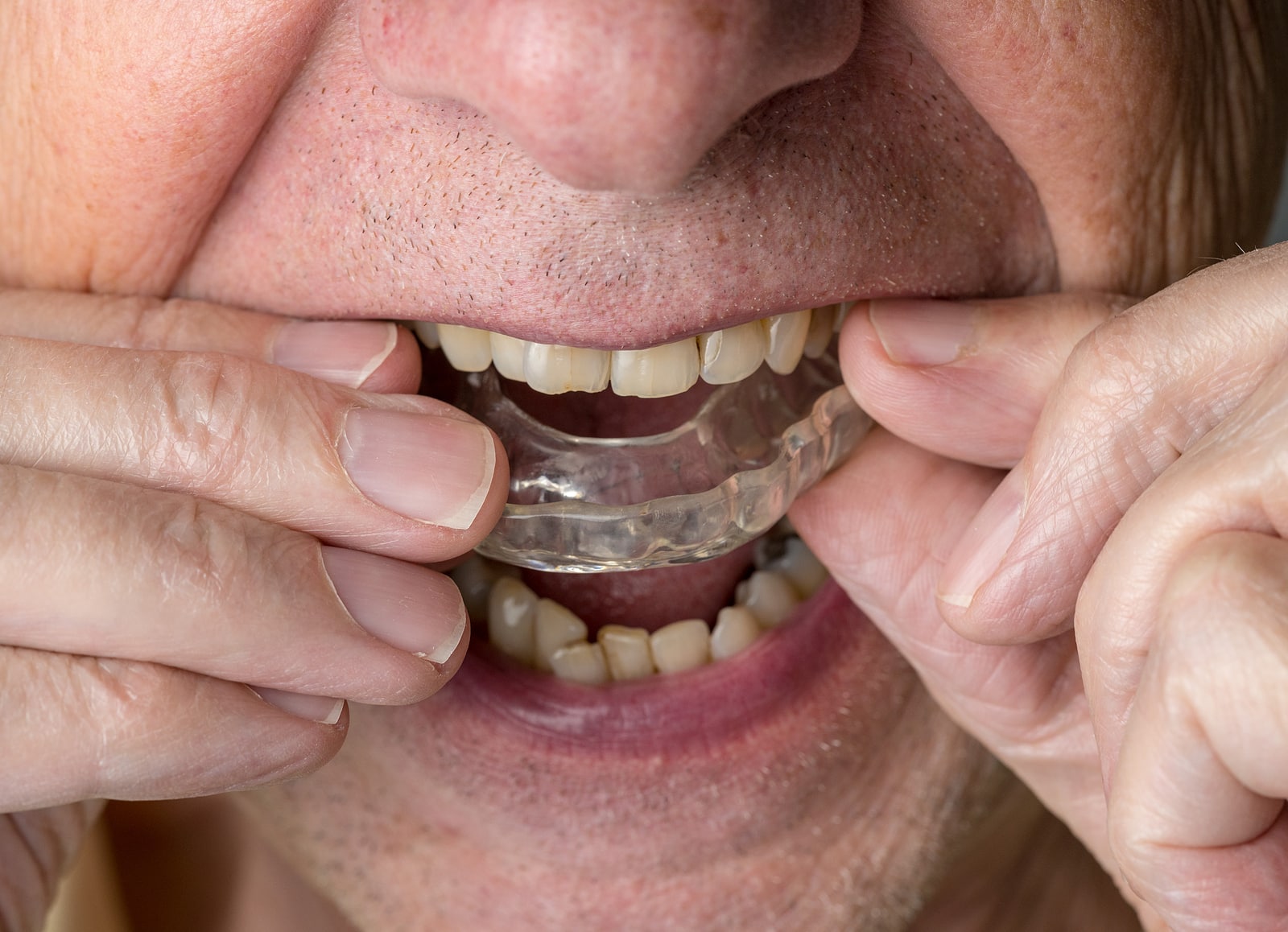 Invisalign and Coffee Tips to Keep Trays Clear
