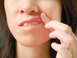 Common Causes of Braces Mouth Ulcers