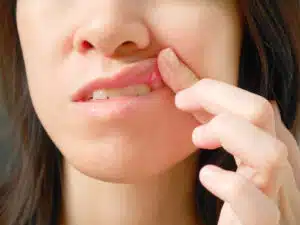 Common Causes of Braces Mouth Ulcers