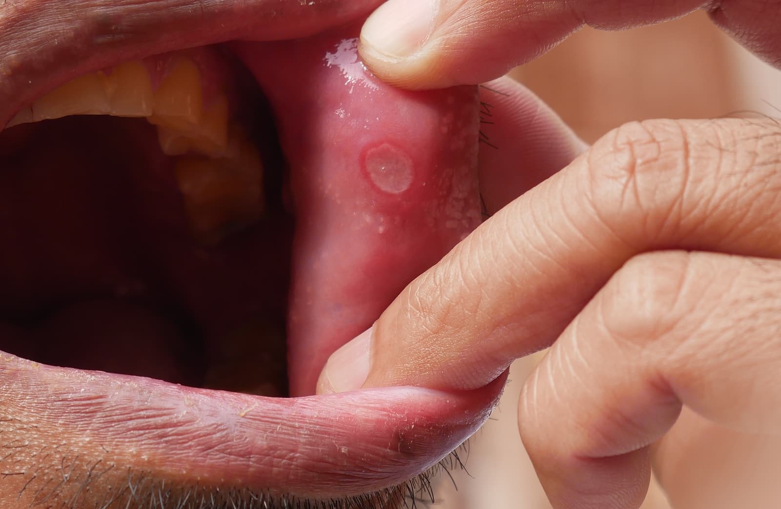 Mouth Ulcer from Braces Treatment and Relief