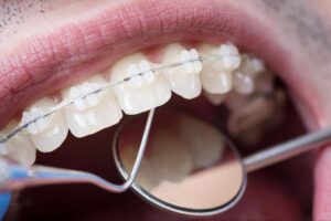 Orthodontic Evaluation for Crooked Teeth