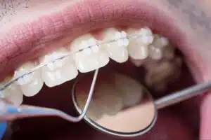 Orthodontic Evaluation for Crooked Teeth