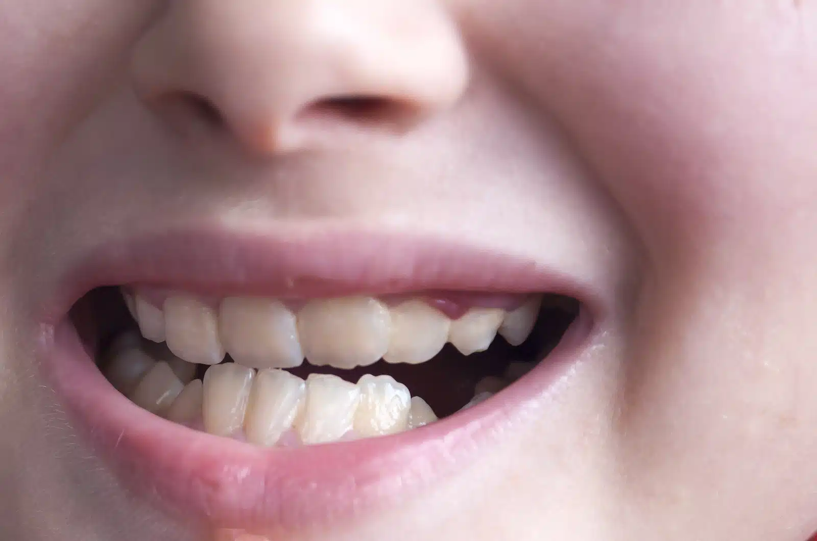 Orthodontic Treatment Effects on Appearance