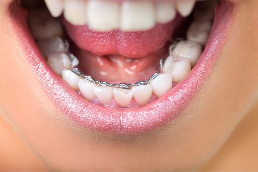 A close-up of lingual braces on lower teeth