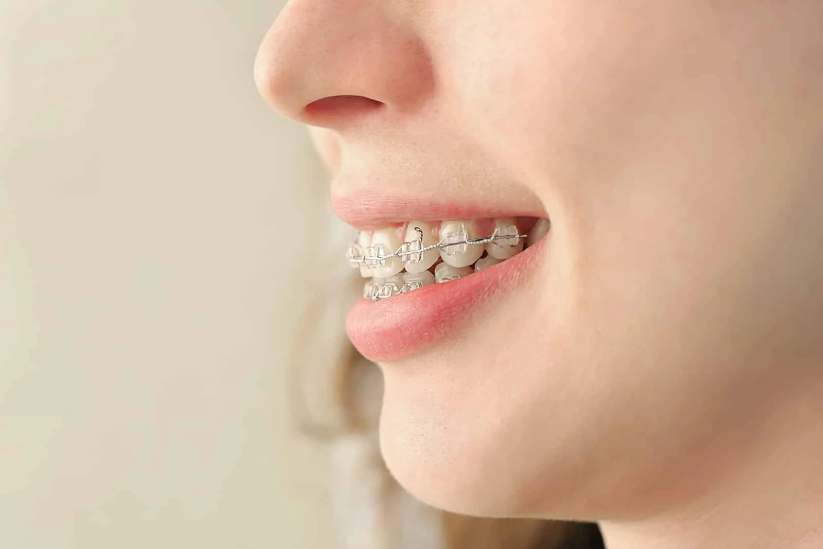 Do Braces Change Your Face Guide