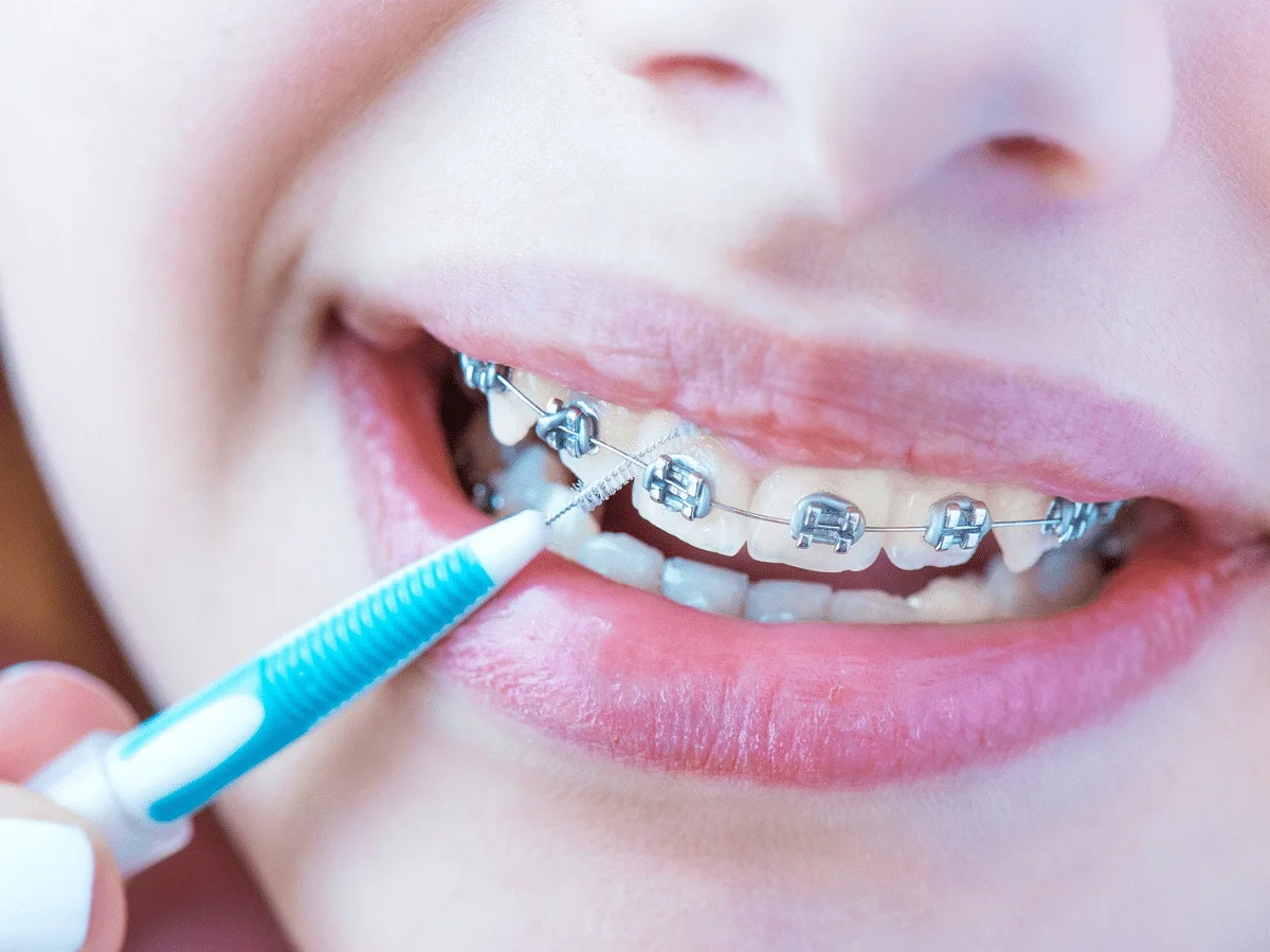 Close-up of a person cleaning braces with an interdental brush, showing the pain timeline in action